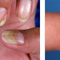 Nail Mold vs Fungus: Symptoms and Treatments You Must Know