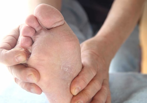 Surprising Causes Revealed: What Is Athlete's Foot Fungus Between the Toes and Where It Comes From