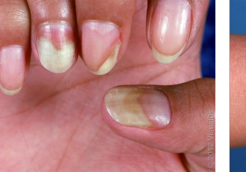Nail Mold vs Fungus: Symptoms and Treatments You Must Know